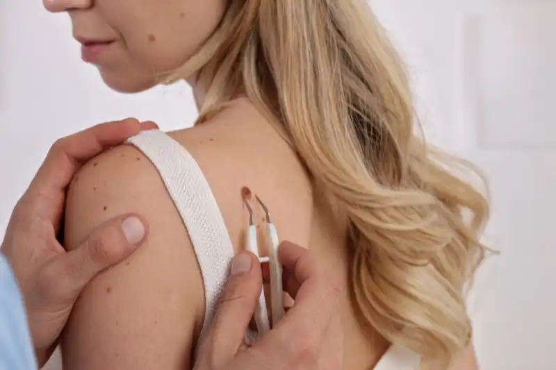 Close-up of a medical professional using an instrument to remove a mole on the skin.