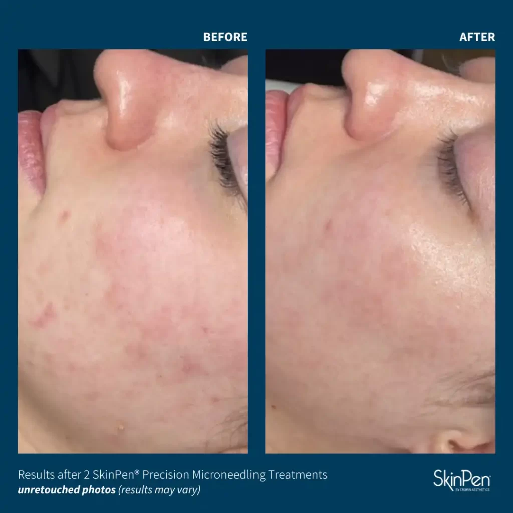 A before and after image of the transformational results of microneedling with SkinPen for a woman’s acne scars.